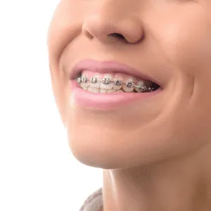 Braces